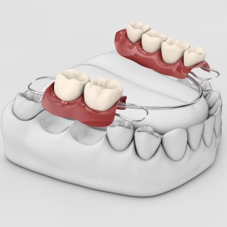 Prótese fixa Implante dentário moderno Sorocaba Lentes de porcelana Sorocaba