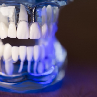 Lentes de contato dental Modelagem digital dental Votorantim Clareamento dental profissional Votorantim