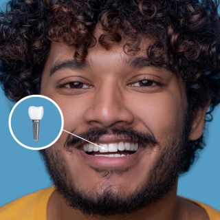 Carga imediata implante Facetas de resina Votorantim Harmonização orofacial estética Votorantim